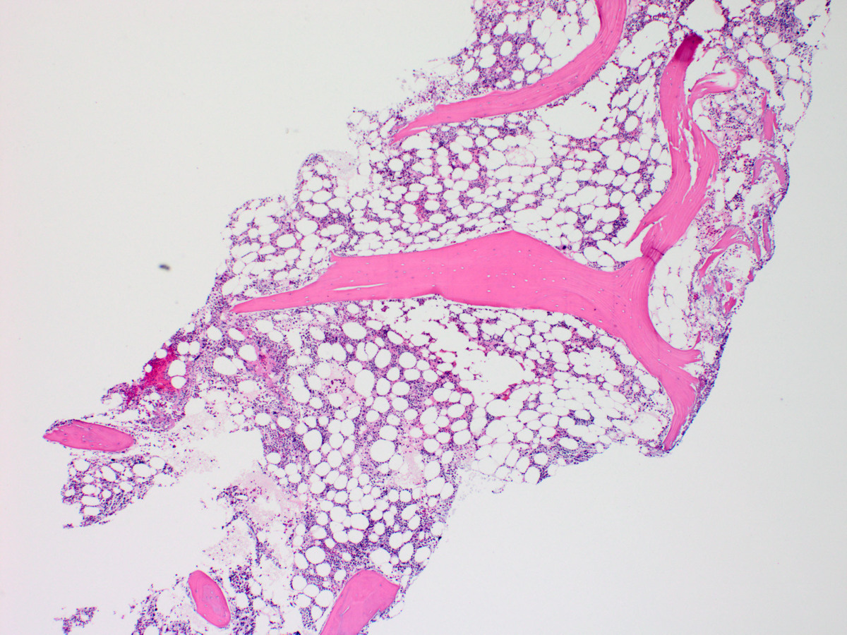Bone marrow biopsy section showing essentially normal cellularity with no abnormal infiltrates (x40, H&E) 